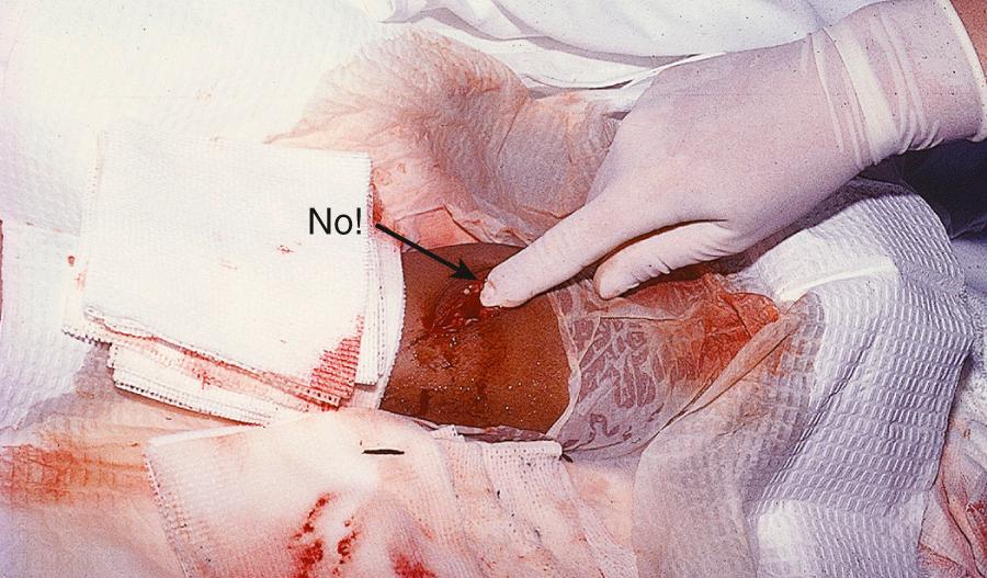 Figure 36.5, What's wrong here? Though historically suggested as a useful technique to find foreign bodies, probing the depths of a wound with a gloved finger may result in a puncture wound in the operator. The practice is strongly discouraged because of the prevalence of hepatitis and human immunodeficiency virus infection.