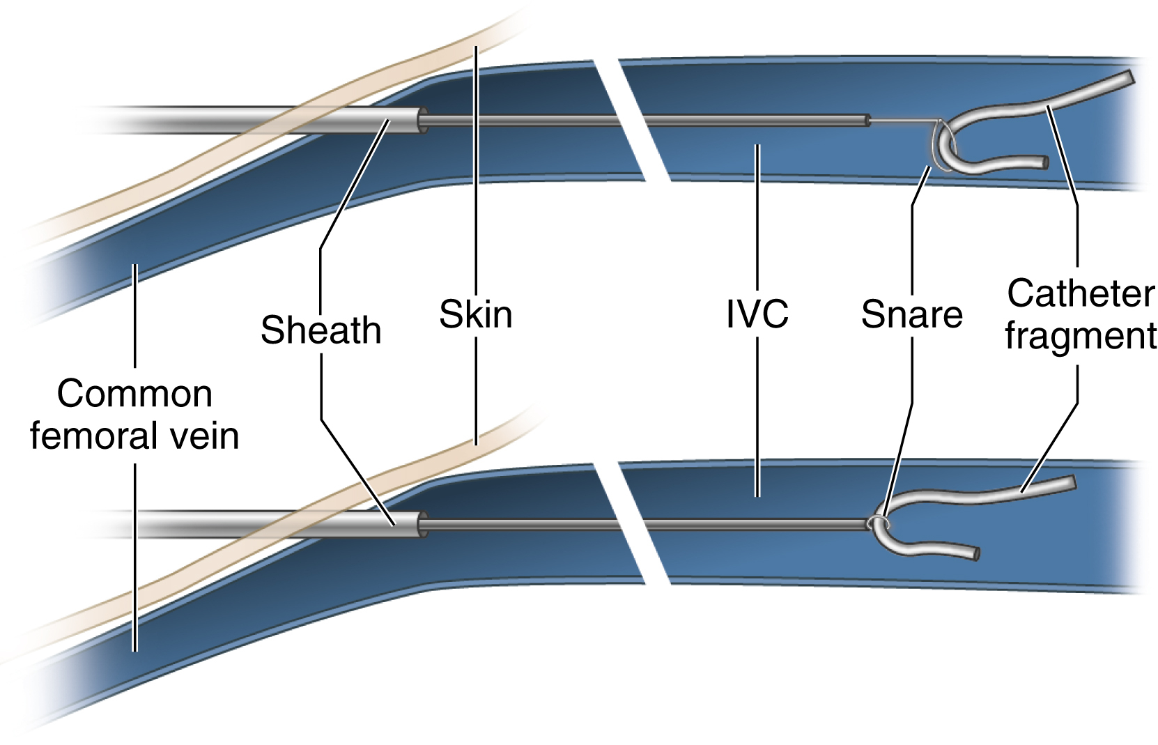 Fig. 74.1, A catheter fragment lost in the inferior vena cava ( IVC ). An Amplatz Goose Neck snare (ev3/Covidien, Plymouth, MN) has been passed through a vascular sheath in the common femoral vein and used to remove the fragment through the sheath.