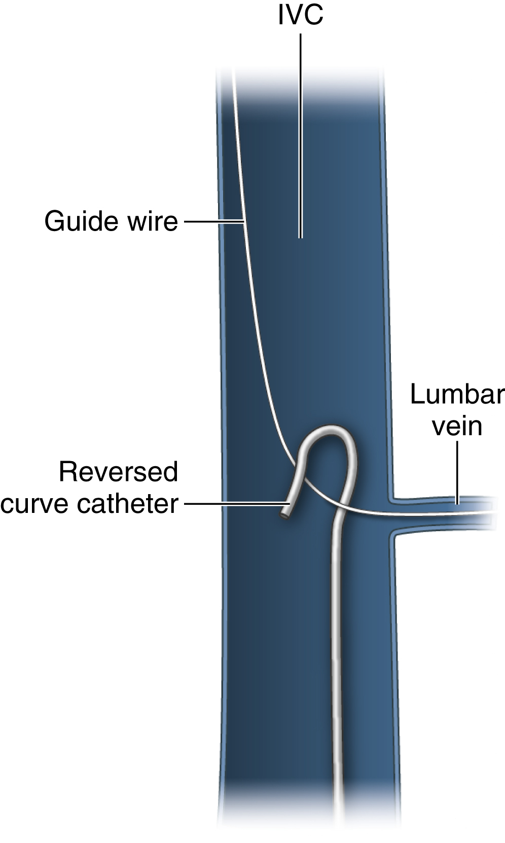 Fig. 74.2, The tip of a lost wire is in a lumbar vein, preventing its being snared with an Amplatz Goose Neck snare (ev3/Covidien, Plymouth, MN). A reverse curve catheter is used to pull the wire tip out of the lumbar vein to facilitate wire removal with a snare. IVC, Inferior vena cava.