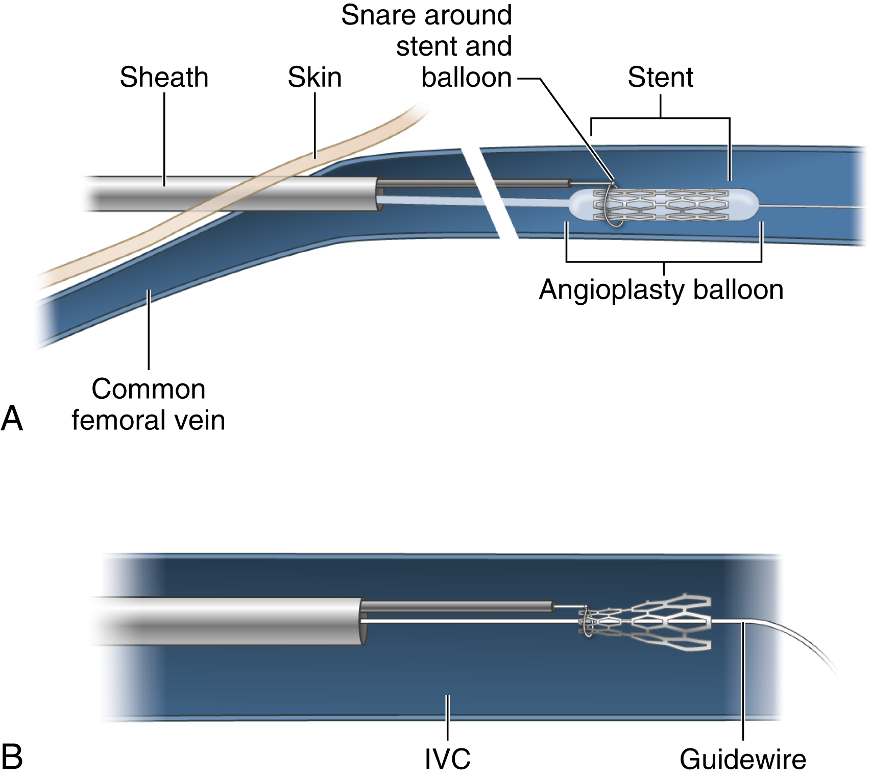 Fig. 74.3, (A) Struts on the free end of lost stent have prevented passage of an Amplatz Goose Neck snare (ev3/Covidien, Plymouth, MN) around it. An angioplasty balloon is placed inside the stent to provide a transition zone for snare to approach and slip over the end of the stent. (B) The balloon has been deflated and pulled into sheath. The end of the stent is constrained by the snare as the stent is pulled out through the sheath. IVC, Inferior vena cava.