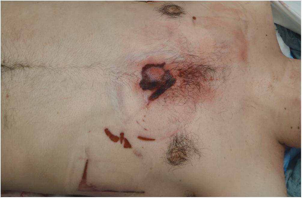 Figure 22.1, Contusions and abrasions over the sternum, resulting from cardiopulmonary resuscitation. Trauma of the underlying soft tissues, sternum, and rib cage may either be absent or extensive, with secondary injuries to the pericardium and heart.