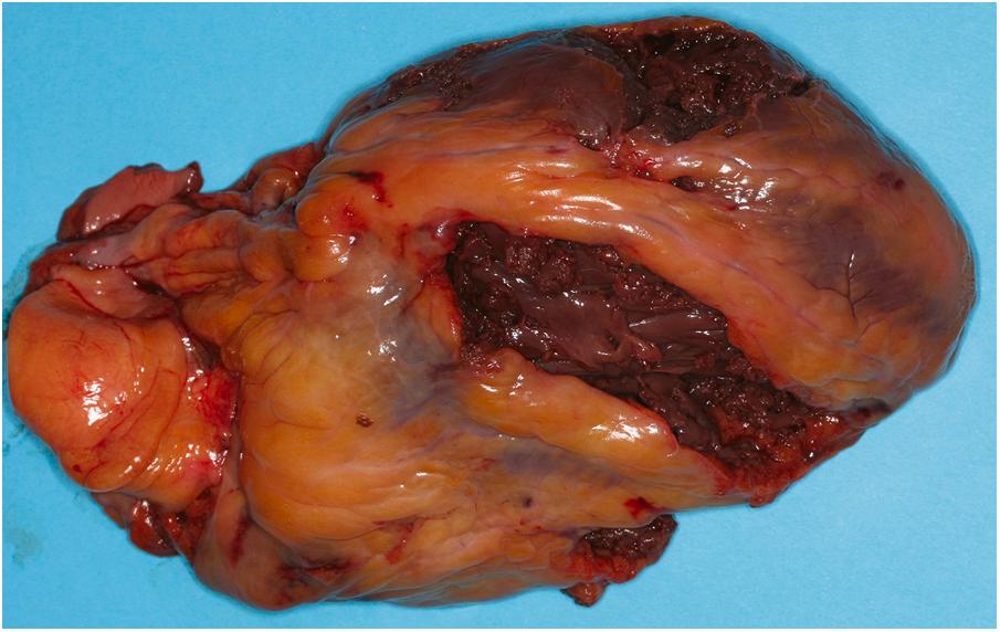 Figure 22.11, Large lacerations of the myocardium resulting from blunt force trauma deceleration forces when a construction worker fell 20 stories.