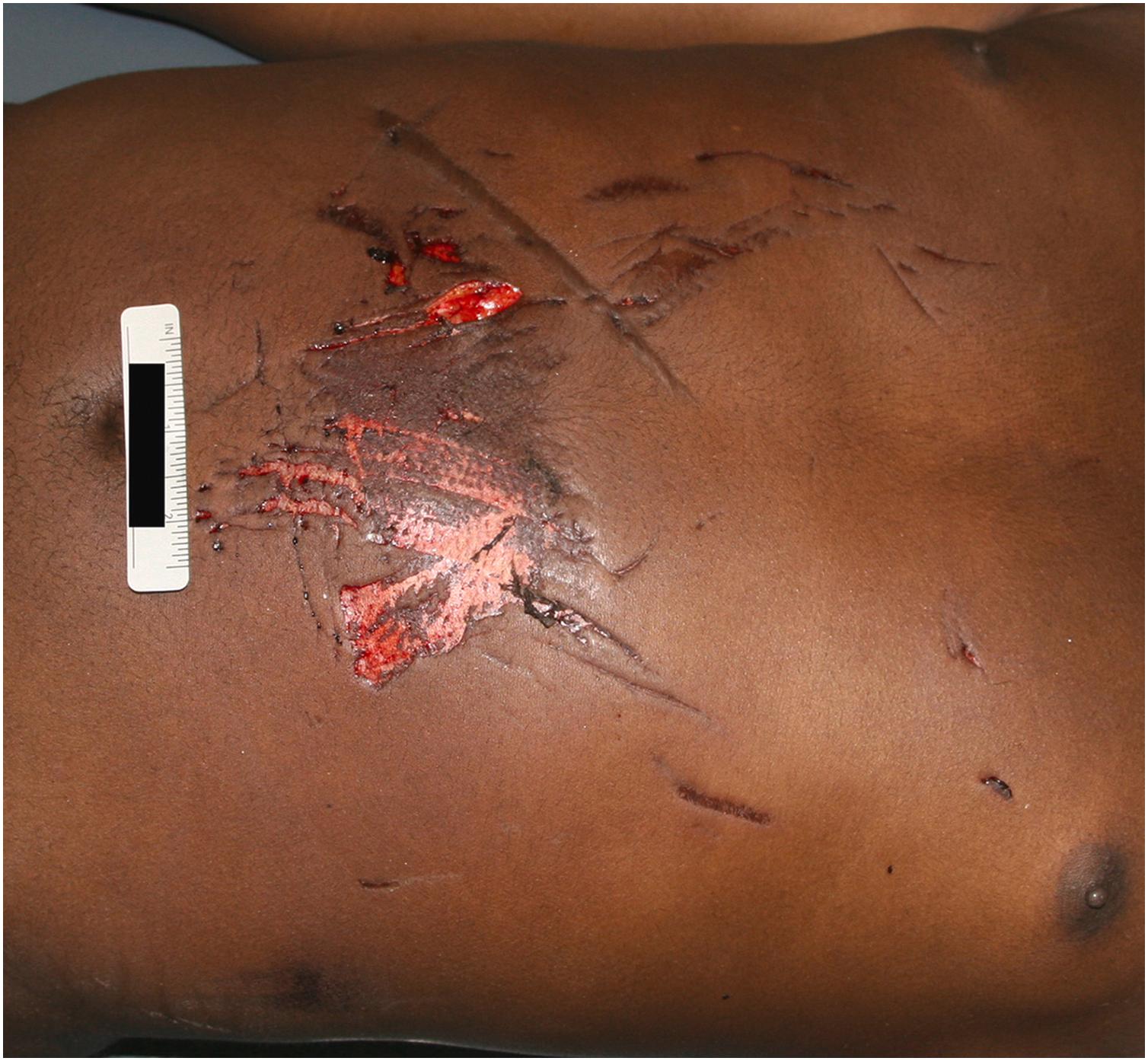 Figure 22.14, This decedent was a nonseat belted driver involved in a head-on motor vehicle collision. External examination showed superficial abrasions of the chest and upper abdomen consistent with an impact with a steering wheel. Internal examination revealed no injuries of the chest wall, heart, lungs, and abdominal organs. Additionally, this decedent had a deep gaping laceration beneath each knee. There was a striking lack of blood at the scene and on the jeans. Histology sections revealed no pathologic changes in the organs. The toxicology evaluation revealed the decedent was intoxicated with alcohol at nearly three times the legal driving limit. Given the scene investigation and the negative findings at autopsy, the cause of death was determined to be commotio cordis.