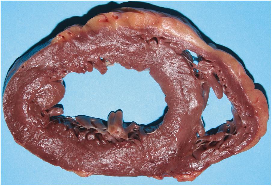 Figure 22.15, Cross-section of the heart showing a concentrically thickened left ventricle with dilatation of the ventricle chamber. This decedent experienced sudden death following many years of known clinical hypertension.