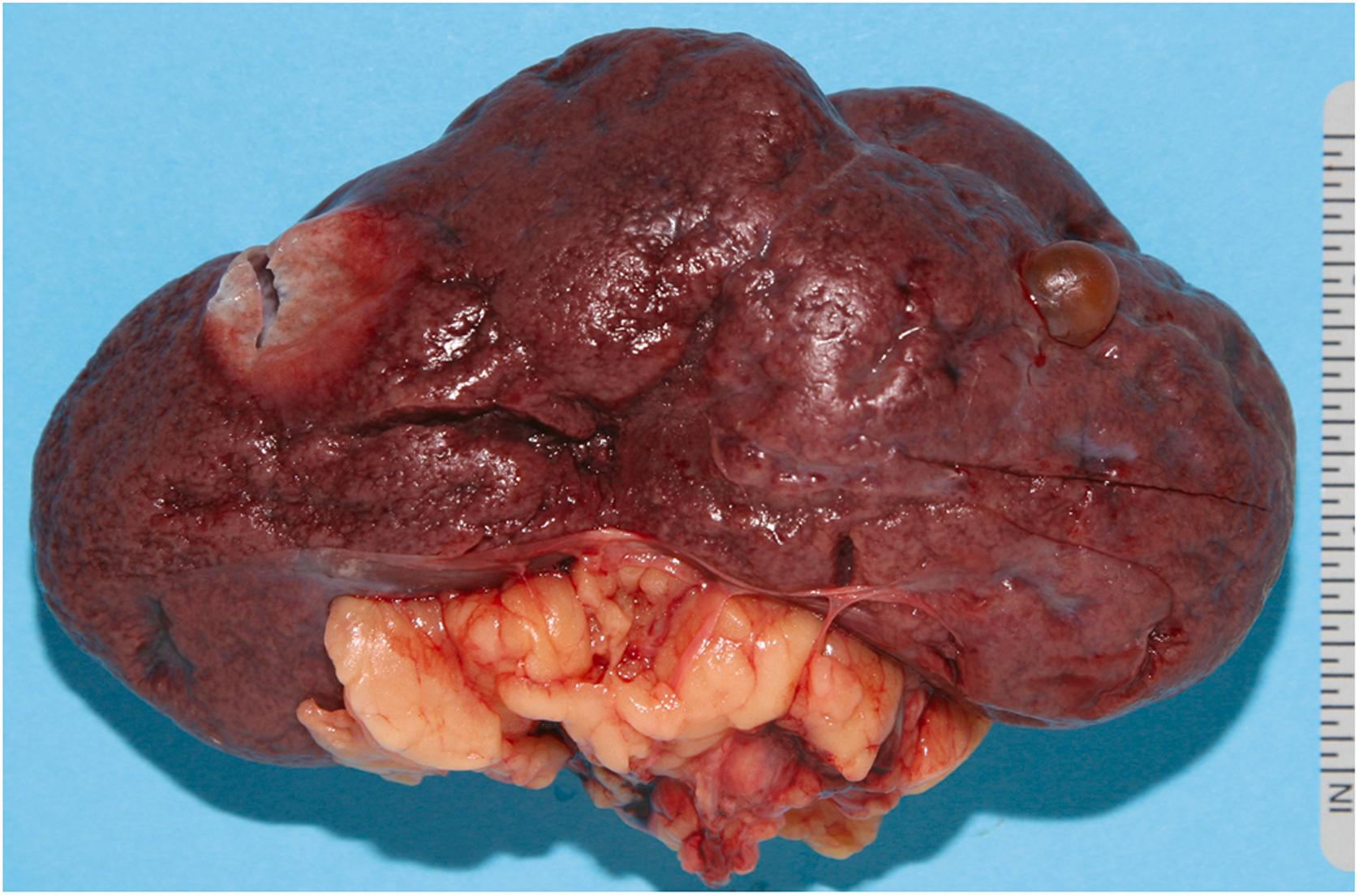 Figure 22.16, External surface of the right kidney showing pitting, granularity, and a few cortical cysts, consistent with arteriolonephrosclerosis and degeneration from hypertensive cardiovascular disease.