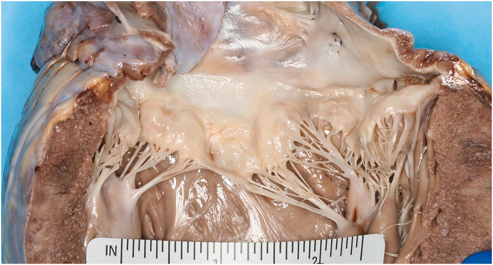 Figure 22.17, Fibrous thickening of the mitral valve and chordae tendineae in a decedent with long-standing mitral valve prolapse.