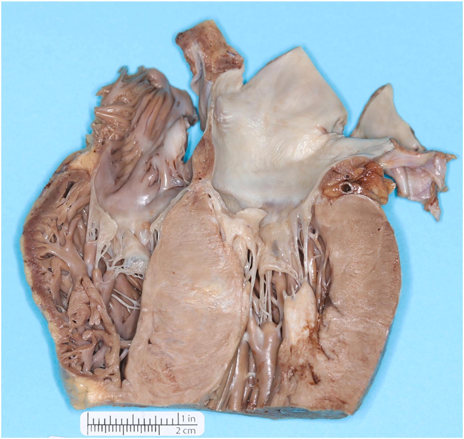 Figure 22.18, Sudden death occurred in this young man while running for exercise. He had no past medical history; he complained of acute chest pain and collapsed. The heart was grossly enlarged, and the left ventricle was palpably thick. After formalin fixation, the heart was cut to show the four chambers and revealed a markedly thickened interventricular septum bulging into the left ventricular outflow tract. Microscopic examination revealed myocyte disarray in the interventricular septum consistent with hypertrophic cardiomyopathy and molecular genetics revealed two variants of uncertain significance (p. Gly50Ser and p. Gu575Ter in the ACTC1 and KCNB2 genes, respectively). Of note, in some cases, the left ventricular and interventricular septum can be nearly symmetrically thickened.