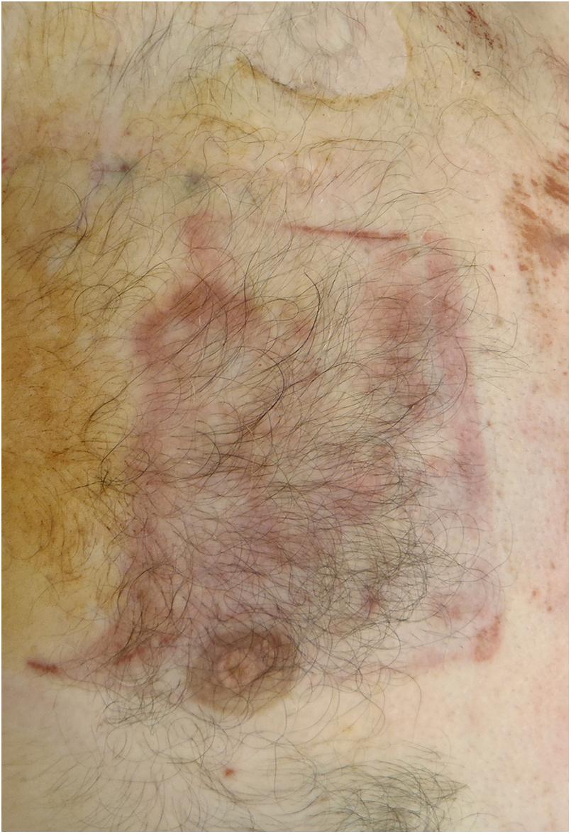 Figure 22.2, Rectangular contusion on the upper chest where a disposable defibrillator pad previously overlaid the skin.