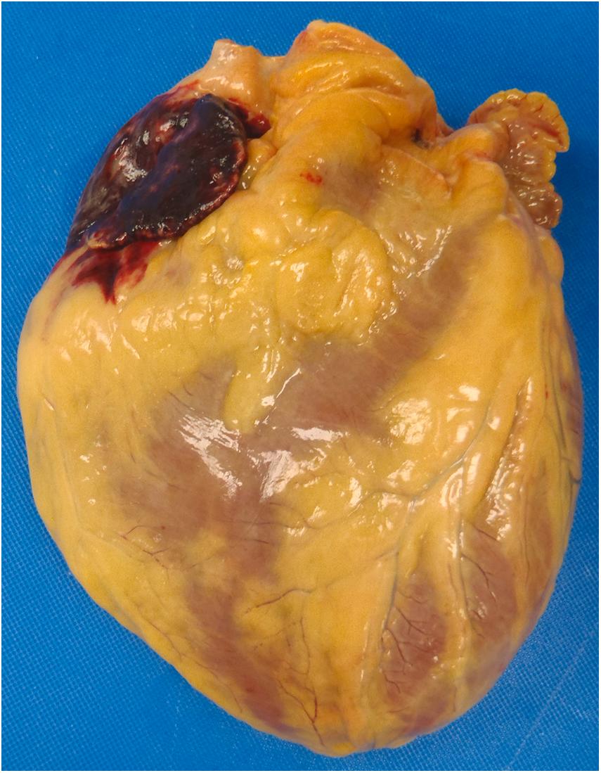 Figure 22.3, Hemorrhagic contusion of the right atrium following cardiopulmonary resuscitation.