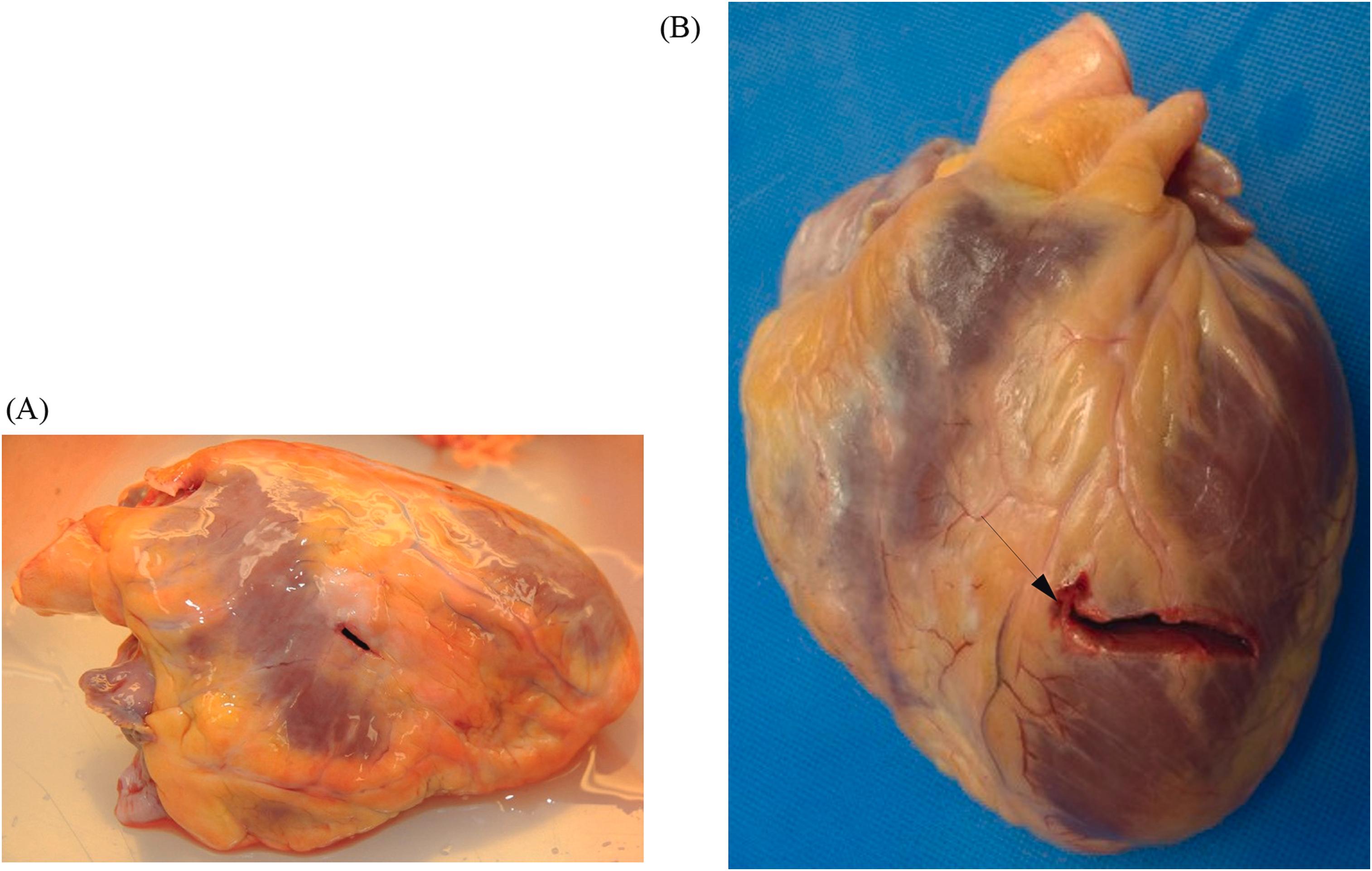 Figure 22.4, (A) Stab wound of the anterior right ventricle with well-preserved features of the knife apparent on the epicardial surface, with a blunt edge of the knife situated superior and a sharp edge inferior. (B) Stab wound of the anterior left ventricle that is slightly irregular on the epicardial surface with a curved edge (arrow), consistent with movement of the knife or the body while the knife was within the heart.