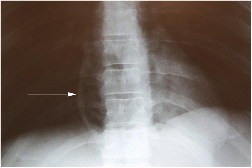 Figure 22.5, X-ray of the chest from a decedent who stabbed himself in the neck many times to commit suicide. Note the radiolucent region within the right heart (arrow) indicating a large air embolus. Injuries to the vessels, particularly of the neck, may allow air to enter the circulatory system. The air can travel to the heart if circulation persists and can embolize within the right heart, causing death. To identify an air embolus in the heart, it is helpful to X-ray the decedent before performing an autopsy.