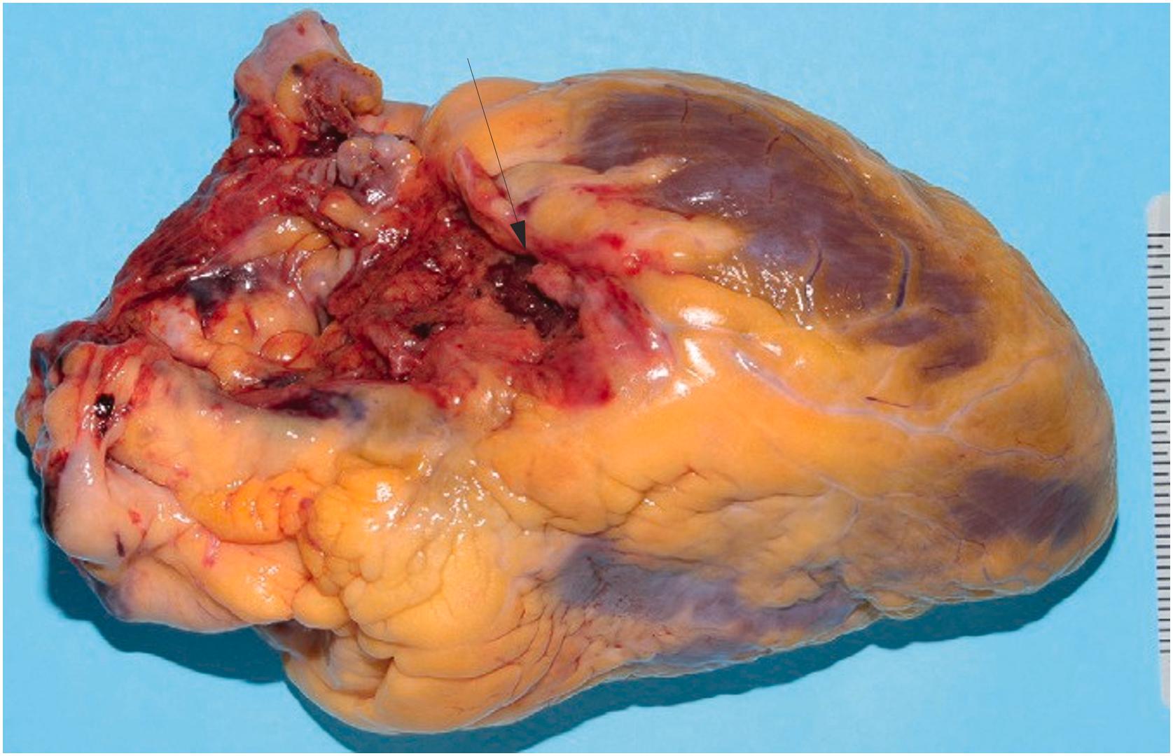 Figure 22.6, Gunshot wound of the left atrium (arrow) with surrounding epicardial hemorrhage. Note the small size of the gunshot wound defect. This wound was caused by ammunition from a handgun.