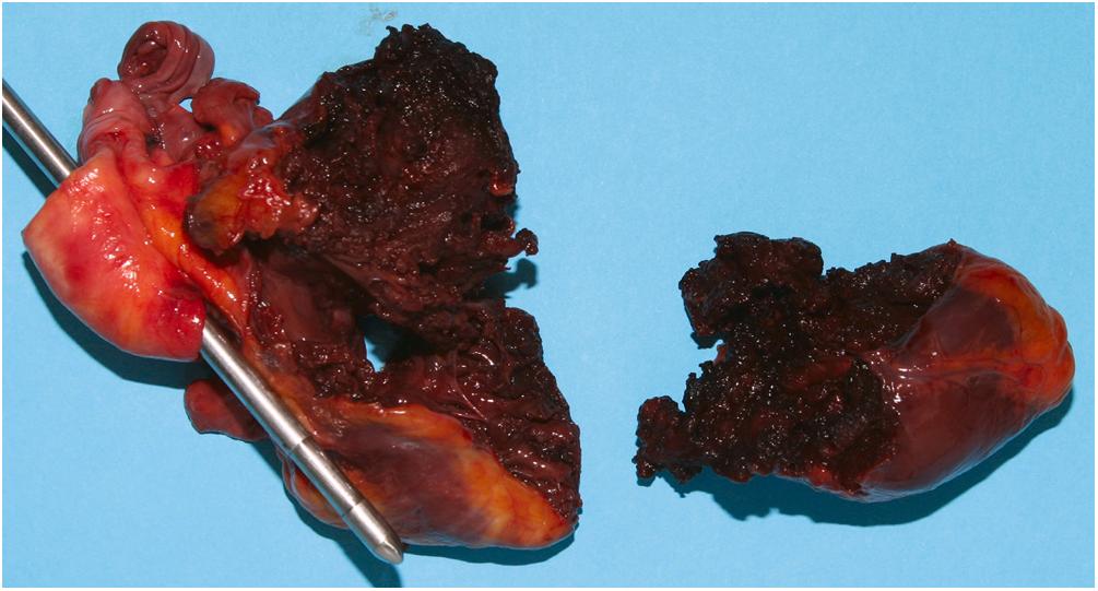 Figure 22.9, Extensive laceration with transection of the apex of the heart resulting from blunt force trauma deceleration forces in the driver of a motorcycle that crashed while traveling at a high speed.