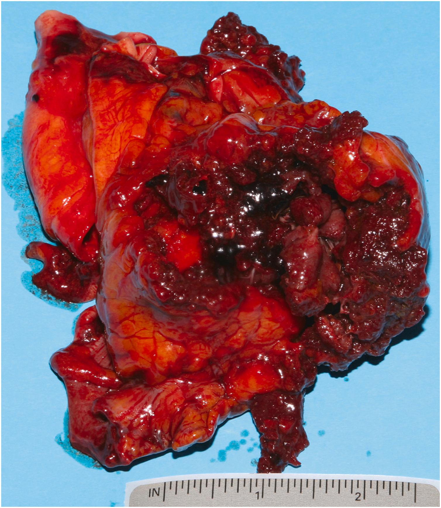 Figure 22.10, Extensive lacerations and pulpification of the heart from blunt force trauma deceleration forces and penetrating injuries from pieces of debris from an aerial impact between two small aircrafts.