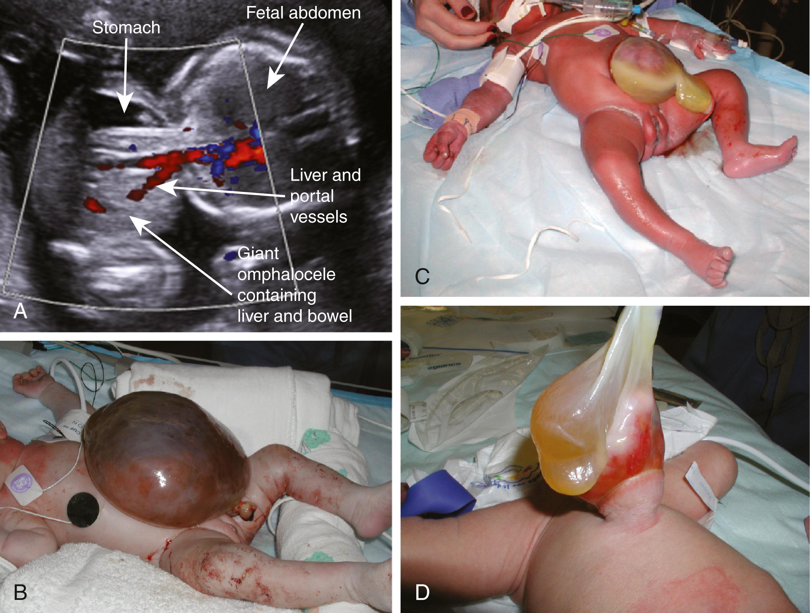 Fig. 4.4, Omphalocele