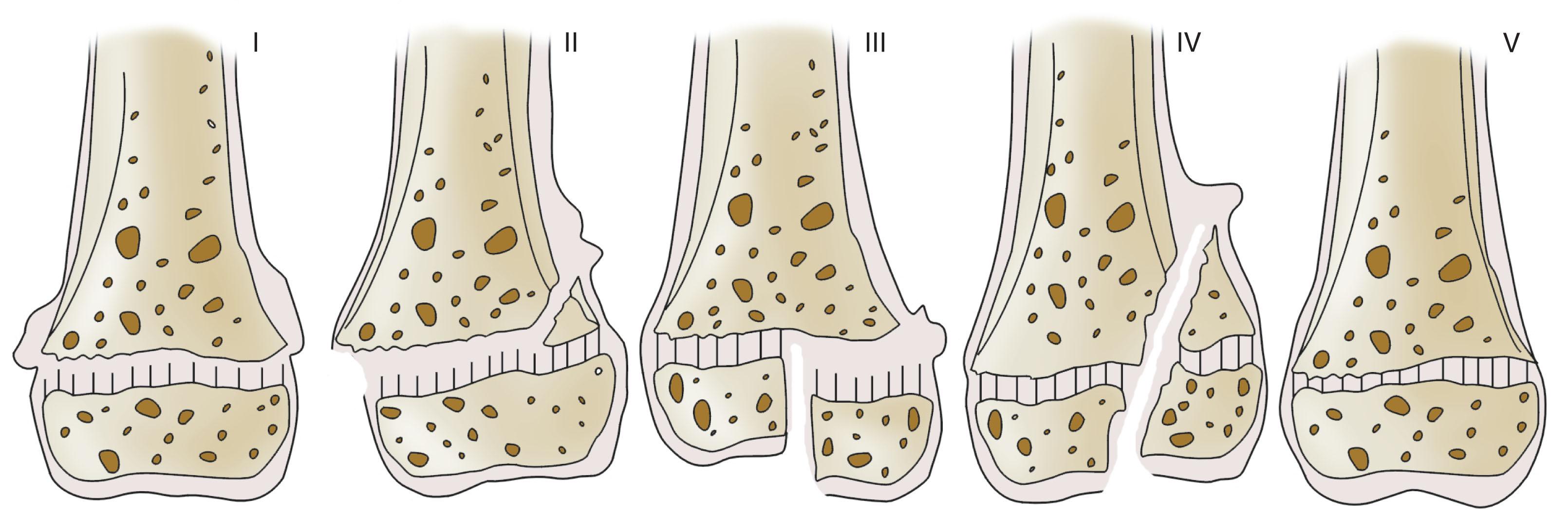 Figure 198.2, The types of growth plate injury as classified by Salter and Harris. See text for descriptions of types I to V.