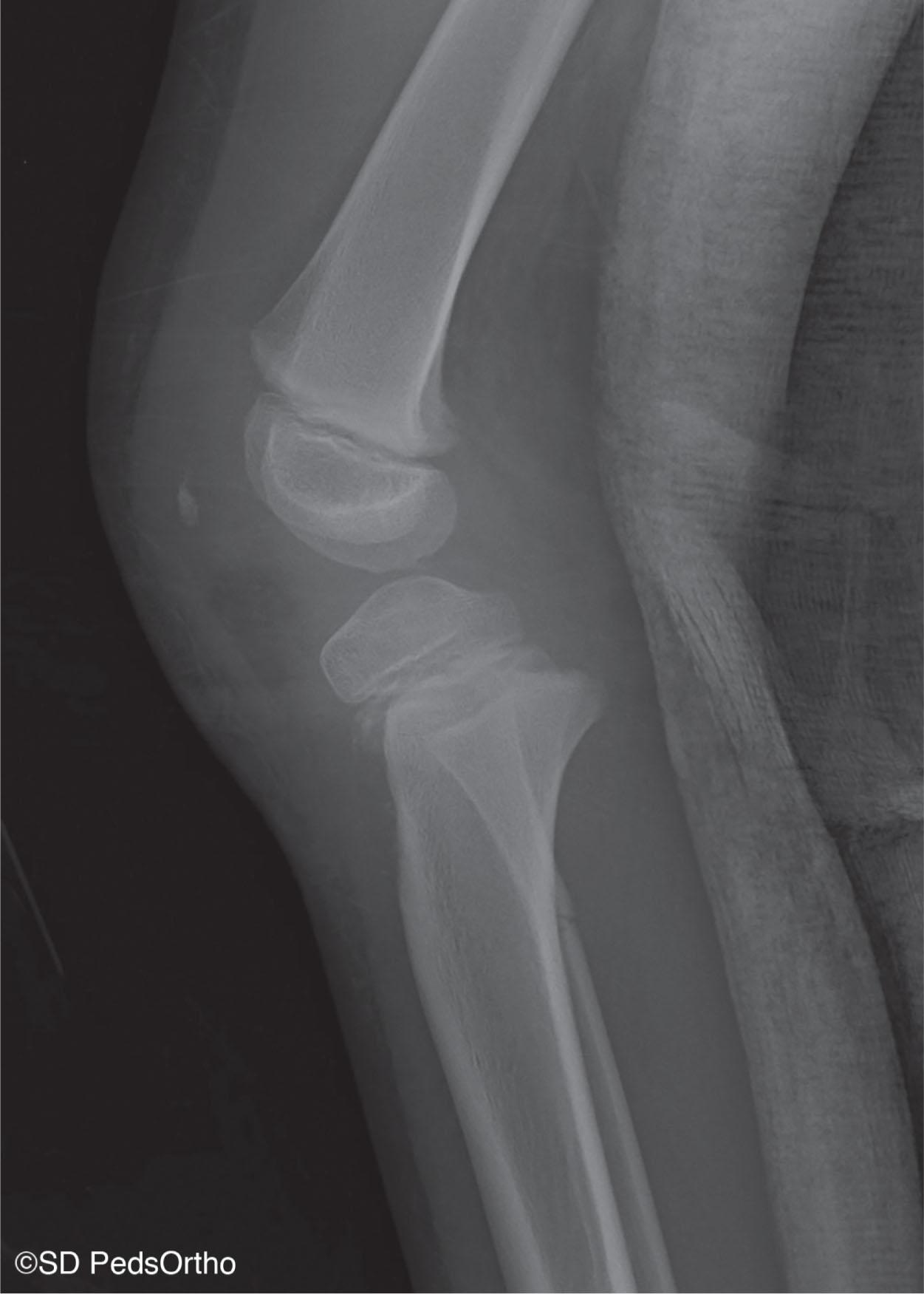 Fig. 12.1, An Extension-Type Proximal Tibial Physeal Fracture. This demonstrates displacement of the proximal tibial metaphysis posteriorly that can lead to injury of the tethered popliteal artery
