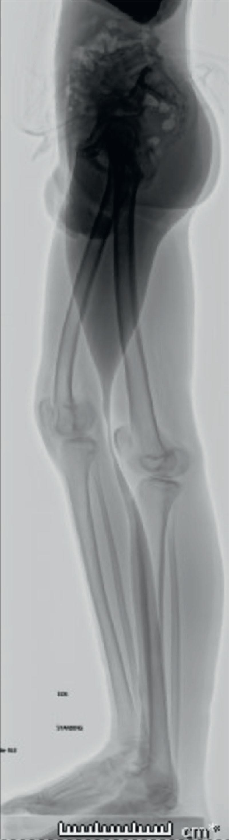 Fig. 12.2, Lateral Standing Lower Extremity Radiograph of a 17-Year-Old Male. This is 6 years after sustaining a nondisplaced distal femoral physeal fracture. The right femur is 6.5 cm shortened compared to the left femur. The distal femur also demonstrates a distal femoral knee flexion deformity secondary to a distal femoral post-traumatic physeal arrest.