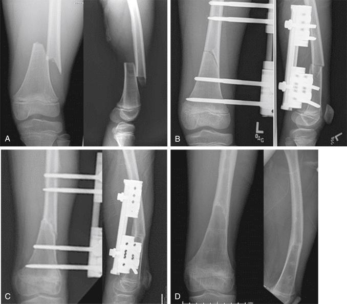 Fig. 13.1, Radiographs of a 9-year-old boy who sustained a fracture of the distal end of the femur. (A) Anteroposterior and lateral radiographs of the distal part of the femur and knee showing a distal femoral fracture, with significant displacement and shortening. (B) The fracture was reduced in the operating room, and the reduction was held with an external fixator. (C) Anteroposterior radiograph of the knee and distal end of the femur showing healing of the fracture 3 months after the injury. (D) Radiograph obtained 1 year after the injury demonstrating good distal femoral alignment and advanced remodeling.