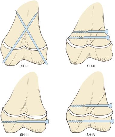 Fig. 13.11, Stabilization techniques for distal femoral epiphyseal fractures using smooth pins or partially threaded cancellous lag screws.