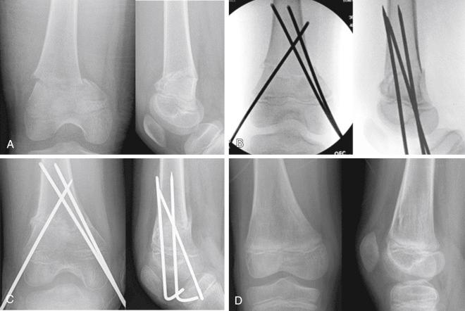 Fig. 13.2, A 10-year-old boy sustained an injury to his right knee. (A) Anteroposterior and lateral radiographs of the distal end of the femur show a complete supracondylar femoral fracture with medial displacement and extension of the distal fragment. (B) Because of the proximity of the injury to the physis, the fracture was reduced and pinned percutaneously. (C) Three weeks after surgery, early signs of healing are noted, and the pins are removed. (D) Six months after surgery, the fracture has healed in an anatomic position, and the distal femoral physis appears to be viable.