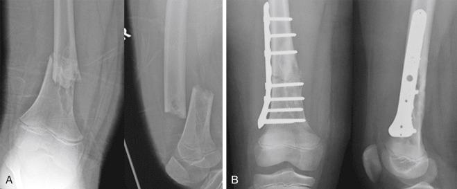 Fig. 13.3, An 8-year-old boy sustained a twisting injury to his leg while running. (A) Anteroposterior (AP) and lateral radiographs of the distal femur demonstrating a pathologic fracture of the distal femur through a nonossifying fibroma. (B) AP and lateral radiographs after application of a submuscular bridge plate showing excellent alignment of the fracture.