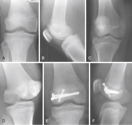 Fig. 13.4, (A and B) Anteroposterior and lateral radiographs of a 15-year-old boy who sustained an injury to his knee. Radiographs do not reveal an obvious fracture. (C) An oblique radiograph shows a Salter-Harris type III fracture of the physis of the distal femur. (D through F) The fracture was treated with open reduction and internal fixation. Radiographs show that excellent alignment of the fracture was achieved.