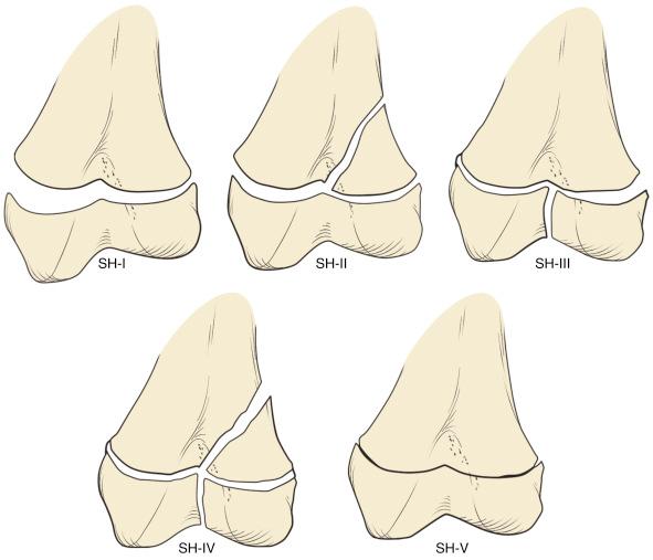 Fig. 13.5, Salter-Harris classification system for distal femoral epiphyseal injuries.