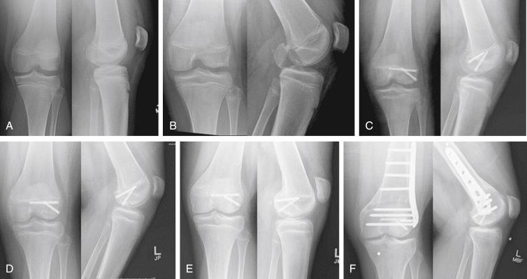 Fig. 13.6, (A) Anteroposterior and lateral radiographs of the distal femur in a 12-year-old boy who sustained a coronal shear fracture of the lateral femoral condyle. The fracture line is barely visible on the lateral radiograph and was not diagnosed. (B) The patient was next seen 2 weeks later. Radiographs clearly show the fracture. (C) The fracture was treated by open reduction and internal fixation. (D) Six months later, the fracture is healed, and the patient has fully recovered the function of his knee. (E) The patient is lost to follow-up and returns 4 years later with a valgus deformity caused by premature physeal closure of the lateral aspect of the distal femoral physis. (F) A corrective osteotomy is performed, obtaining restoration of the anatomic alignment.