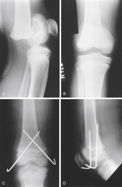 Fig. 13.7, Salter-Harris type I fracture of the distal femoral physis in a 13-year-old boy. The patient sustained a hyperextension injury of the knee without any neurovascular injury. (A) Lateral radiograph of the knee showing a completely displaced Salter-Harris type I physeal injury of the distal end of the femur along with anterior displacement of the femoral condyles. (B) Anteroposterior (AP) radiograph of the same knee demonstrating displacement of the condyles. (C) AP radiograph after closed reduction and percutaneous pinning showing anatomic restoration of the fracture. Note that the pins are smooth and have crossed the physis. (D) Lateral radiograph of the knee showing anatomic reduction of the fracture.