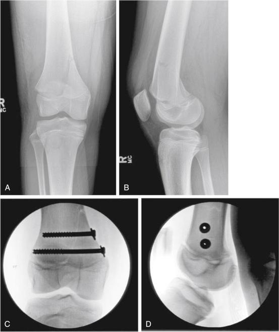 Fig. 13.8, (A and B) Anteroposterior (AP) and lateral radiographs of the distal femur in a 15-year-old boy who sustained a Salter-Harris type II fracture of the distal femoral physis. (C and D) AP and lateral radiographs after closed reduction and stabilization of the fracture with two cannulated screws.