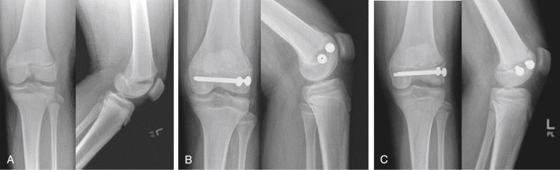 Fig. 13.9, (A) Anteroposterior and lateral radiographs of the distal femur in a 12-year-old boy who sustained a Salter-Harris type III fracture of the distal femoral physis. (B) Radiographs obtained 1 month after an open reduction and internal fixation with all-epiphyseal screws was performed. (C) Four months after the original injury, the fracture is healed in an anatomic position.
