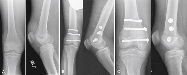 Fig. 13.10, (A) Anteroposterior and lateral radiographs of the distal femur in a 16-year-old boy who sustained a Salter-Harris type IV fracture of the distal femoral physis. (B) Radiographs obtained 1 month after an open reduction and internal fixation achieved with a combination of metaphyseal and epiphyseal screws. (C) Ten months after the original injury, the fracture is healed in an anatomic position.