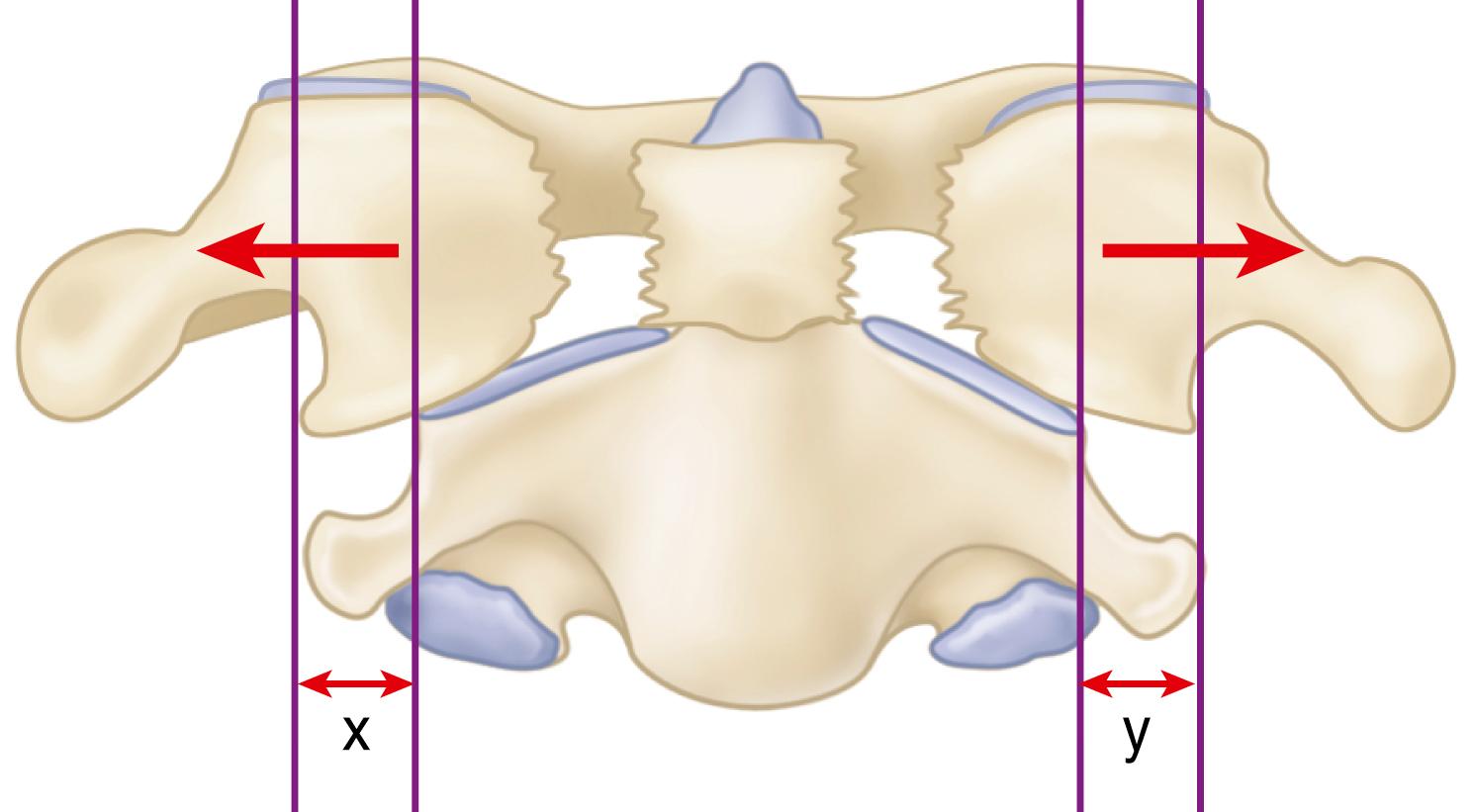 FIGURE 41.16, Displaced fractures with widening of more than 6.9 mm overhang on open-mouth odontoid views suggests injury of the transverse atlantal ligament (rule of Spence).