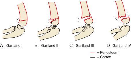 Fig. 17.11, Schematic of the Modified Gartland Classification. (A) Type I fractures are nondisplaced, and the anterior and posterior periosteum is intact. (B) Type II fractures are posteriorly impacted. The anterior cortex may be disrupted. The posterior cortex and periosteum are intact. (C) Type III fractures are characterized by complete disruption of the anterior and posterior cortices. The anterior periosteum is disrupted, but the posterior periosteum remains intact. (D) Type IV fractures are characterized by disruption of both anterior and posterior cortices. Both the anterior and posterior periosteum are torn, making these fractures very unstable.