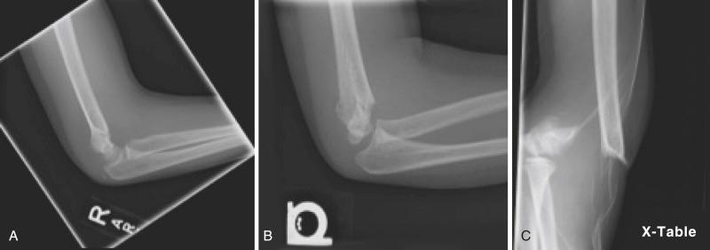 Fig. 17.12, Radiographs showing Gartland type I (A), type II (B), and type III (C) extension supracondylar humeral fractures.