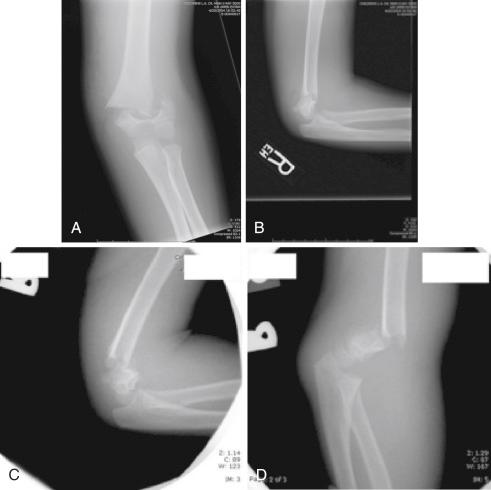 Fig. 17.13, (A and B) Injury radiographs of a multidirectionally unstable supracondylar humeral fracture. (C) Intraoperative image demonstrating fracture instability in flexion. (D) Intraoperative image demonstrating fracture instability in extension.
