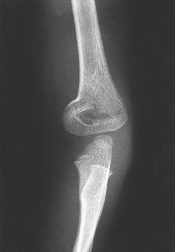 Fig. 17.14, Anteroposterior radiograph of the distal end of an elbow shows a nondisplaced supracondylar fracture with impaction of the metaphysis medially. The lateral column is intact. The deformity produced by this injury should be corrected to prevent persistent angular malalignment (cubitus varus) when the fracture heals.
