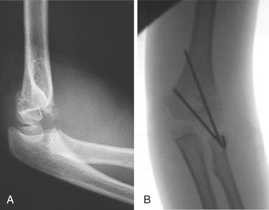 Fig. 17.15, Type II supracondylar humeral fracture. (A) Lateral radiograph of the elbow shows posterior angulation of the distal humeral fragment. The anterior humeral line does not intersect any part of the capitellum. The distal fragment is rotated. (B) Postreduction anteroposterior radiograph showing fixation with divergent lateral entry pins.