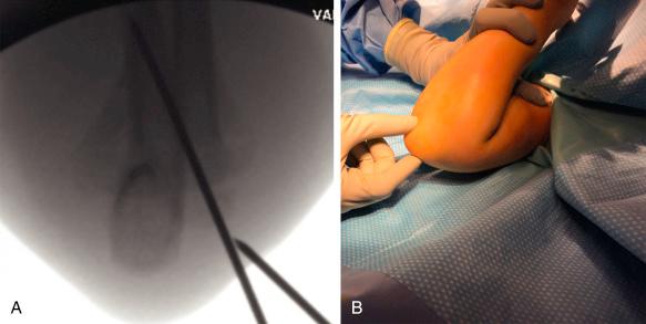 Fig. 17.16, The Jones view is an anteroposterior image of the distal humerus taken through the flexed, overlying forearm. (A) Intraoperative fluoroscopy image demonstrating the Jones view. This view allows for adequate assessment of the medial and lateral columns of the distal humerus and can be used intraoperatively for assessment of reduction and placement of pins. (B) Position of the arm to obtain a Jones view; the elbow is maximally flexed, and the image is taken through the overlying forearm.