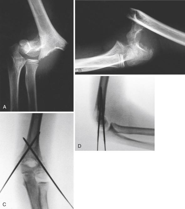 Fig. 17.18, Markedly displaced extension-type III supracondylar humeral fracture reduced with the “milking technique.” (A and B) Anteroposterior (AP) and lateral radiographs show posteromedial displacement of the distal fragment. The anterior spike of the proximal fragment had penetrated through the brachialis muscle and was tenting the skin in the antecubital fossa. Neurovascular status of the extremity was intact. The fracture was reduced by closed means with a “milking technique” to massage the brachialis muscle off the end of the proximal fragment and then pinned percutaneously with the use of crossed medial and lateral entry pins. (C and D) Intraoperative AP and lateral radiographs show anatomic restoration of the distal humerus and the fracture stably fixed with pins crossing above the fracture site.