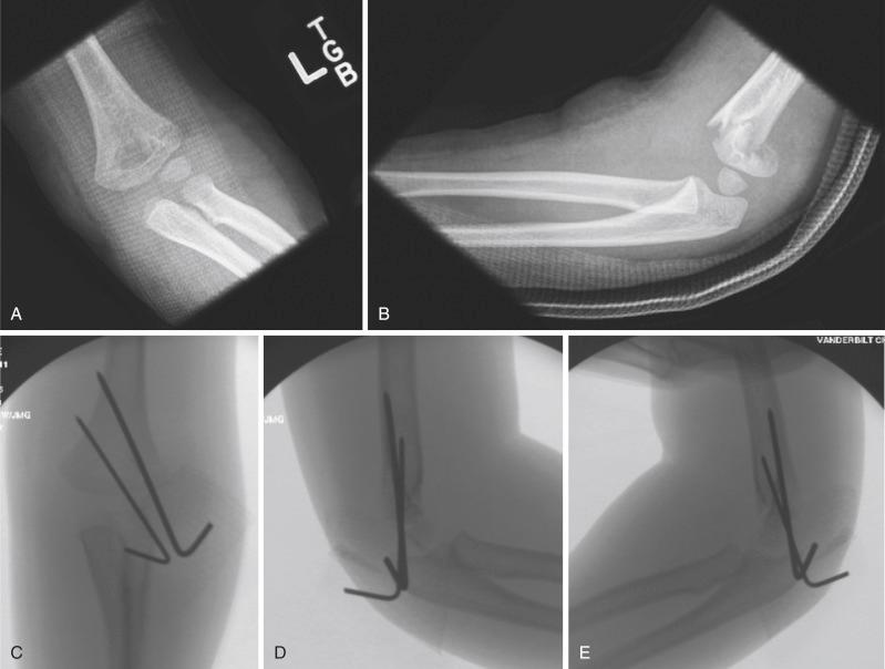Fig. 17.19, A 4-year-old patient with a closed, extension-type II supracondylar humeral fracture. (A and B) Anteroposterior (AP) and lateral radiographs show posteromedial displacement with intact posterior cortex but with rotation of the distal fragment. (C and D) AP and lateral intraoperative fluoroscopic images after closed reduction and pin fixation with two lateral entry pins. Note the slight divergence of the pins and bicortical fixation, both of which are desirable for stability. (E) Internal rotation “stress” view shows a stable reduction with this pin configuration.