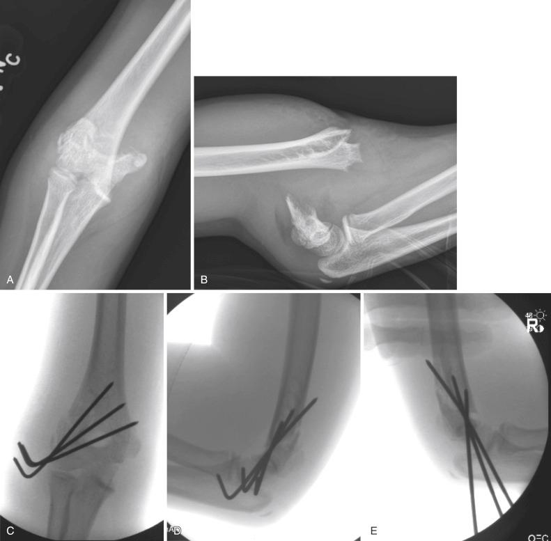 Fig. 17.20, An 8-year-old patient with a widely displaced extension-type III supracondylar humeral fracture that was treated by closed reduction and percutaneous fixation with three lateral entry pins. (A and B) Anteroposterior (AP) and lateral radiographs of the elbow show the fracture and extent of bony displacement and soft tissue disruption. (C and D) Intraoperative AP and lateral fluoroscopic views show a near-anatomic reduction. A third K-wire was placed based on the characteristics of this fracture. (E) Internal rotation “stress” view shows the reduction to be stable. Another fixation option would have been to use a medial entry pin.