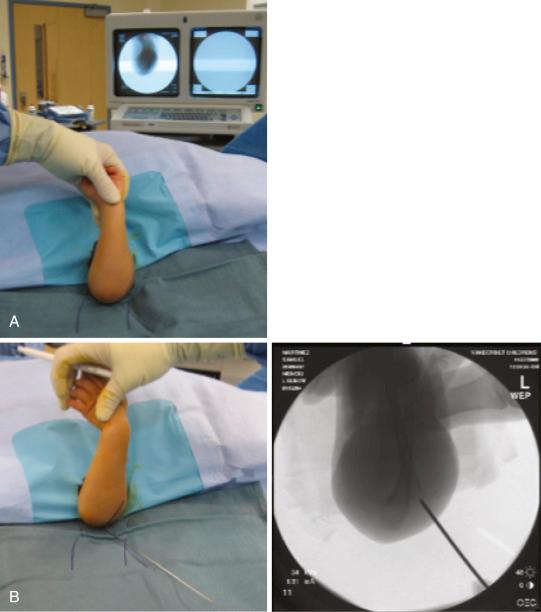 Fig. 17.21, Technique for placement of medial entry pin. (A) Patient is supine with arm draped free on the C-arm platform. (B) The lateral entry pin is placed first, and the fracture is provisionally stabilized. (C) The elbow can then be externally rotated and extended, which allows the ulnar nerve to move away from the medial epicondyle and permits access to the medial epicondyle. A 5-mm incision is made directly over the medial epicondyle, and soft tissue is swept away with a hemostat or elevator. (D) The K-wire can then be positioned directly on the medial epicondyle and driven up the medial column. (E) Anteroposterior and lateral radiographs showing pins crossing above the fracture site and bicortically engaged.