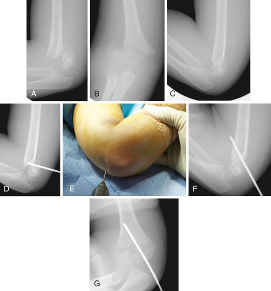 Fig. 17.22, Example of percutaneous leverage pinning to reduce a type III supracondylar humeral fracture. (A and B) Anteroposterior and lateral radiographs show a type III supracondylar humeral fracture. (C) Initial inability to obtain adequate closed reduction. (D) A 2-mm Kirschner wire is placed percutaneously through the triceps tendon, into the fracture site. (E) The surgeon moves hands distally, levering the fracture anteriorly, into more adequate alignment. (F and G) Once adequate alignment is obtained, the wire is advanced through the anterior cortex to maintain reduction. The surgeon can then proceed with lateral or medial pin placement.