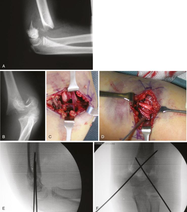 Fig. 17.23, Anterior approach for open reduction of a type III supracondylar humeral fracture. (A and B) Anteroposterior (AP) and lateral radiographs of a type III supracondylar humeral fracture in an 8-year-old patient with median nerve paresthesias and a decreased radial pulse. (C) Anterior approach through a transverse incision in the antecubital flexion crease shows entrapment of the median nerve and tethering of the brachial artery by the fracture. (D) Neurovascular structures were carefully decompressed and freed from the fracture site. The radial pulse improved almost immediately, which allowed the fracture to be reduced. (E and F) AP and lateral radiographs showing anatomic reduction of the fracture and crossed pin fixation.