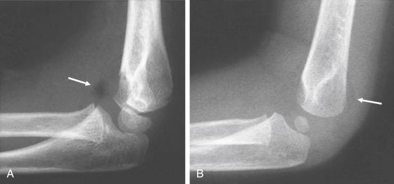 Fig. 17.3, Elevated fat pads anteriorly and posteriorly about the elbow indicate the presence of an elbow effusion. (A) This lateral radiograph of the elbow in a child who sustained a nondisplaced supracondylar fracture shows a markedly displaced anterior fat pad (arrow) . (B) A lateral elbow radiograph of a different child shows no obvious fracture, but both anterior and posterior elevated fat pads can be noted (arrow) . The child was treated for a supracondylar fracture that became evident 3 weeks later with the appearance of a periosteal reaction and a fracture line.