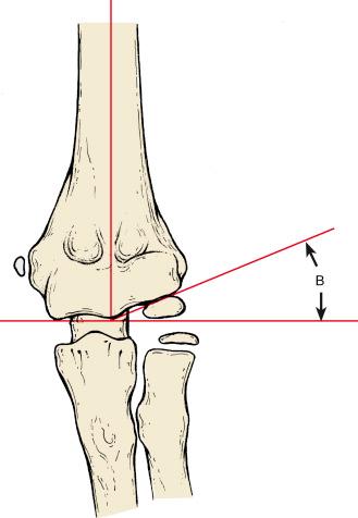 Fig. 17.4, The Baumann angle (B) is formed by the intersection of a line parallel to the metaphysis of the lateral aspect of the distal end of the humerus (i.e., the physis of the capitellum) and a line perpendicular to the longitudinal axis of the humerus. Deviation of more than 5 degrees compared with the contralateral side is abnormal.