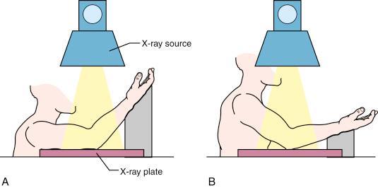 Fig. 17.5, True anteroposterior (AP) radiographs of the elbow are required to accurately assess injury and alignment after a reduction. If the elbow can be fully extended, the AP radiograph of the distal end of the humerus and an AP radiograph of the elbow will be identical. When the elbow is unable to be fully extended, it is necessary to obtain an AP radiograph of the distal humerus. (A) shows the proper orientation of the x-ray beam perpendicular to the distal portion of the arm that will give an undistorted AP rendering of the distal humerus. (B) shows the x-ray beam centered on the elbow. Because the elbow is flexed, the distal portion of the humerus will project tangentially, resulting in distortion of the bony architecture.