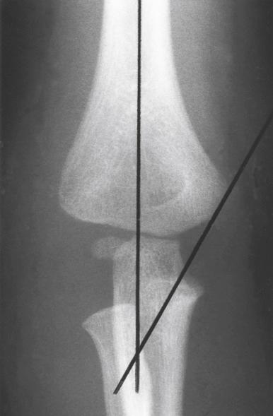 Fig. 17.6, The medial epicondylar epiphyseal angle is measured by the intersection of lines drawn along the medial epicondylar growth plate and the longitudinal axis of the humerus. In this radiograph, the medial epicondyle is not yet ossified; therefore, the line is drawn along the medial border of the distal humeral metaphysis.